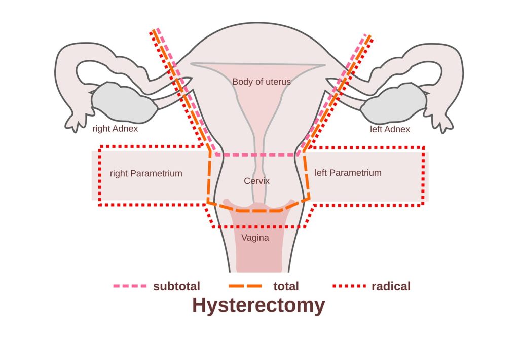 Hysterectomy diagram
