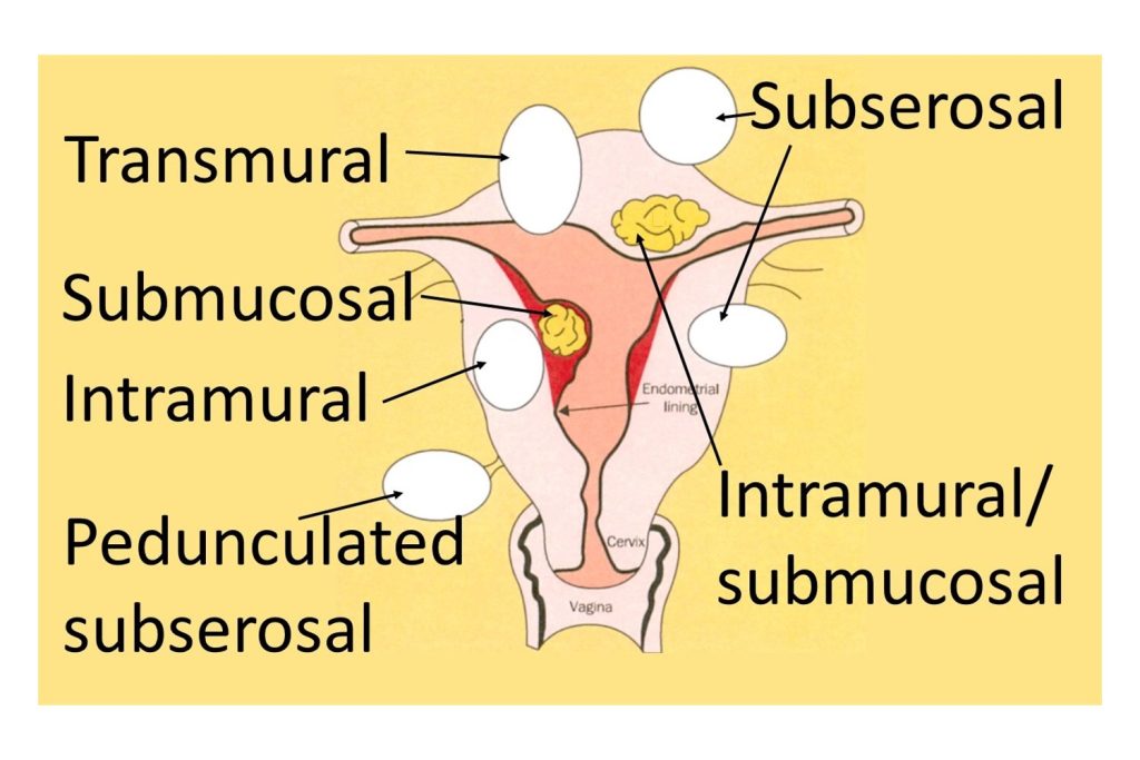 Myomectomy diagram